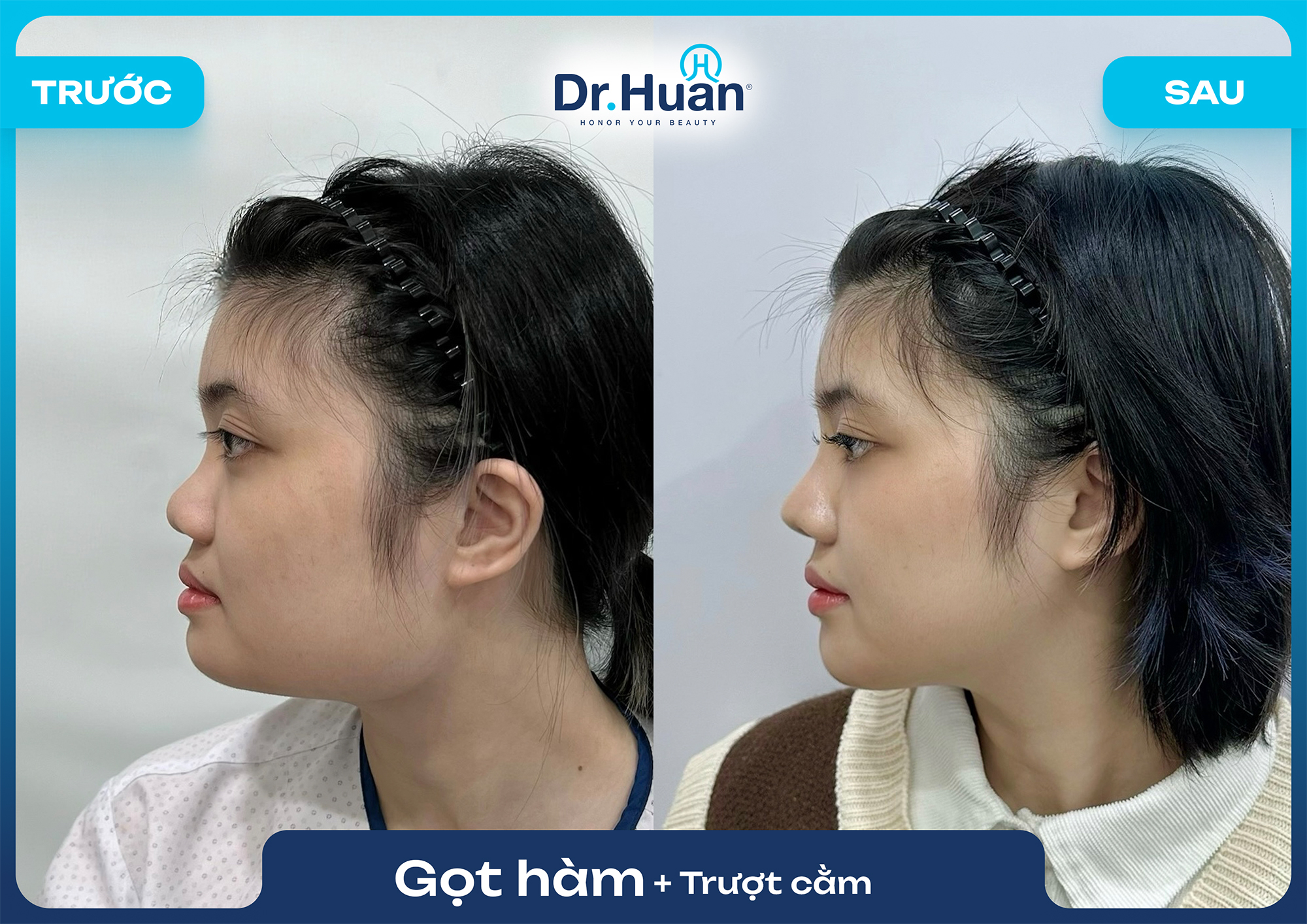 gọt hàm