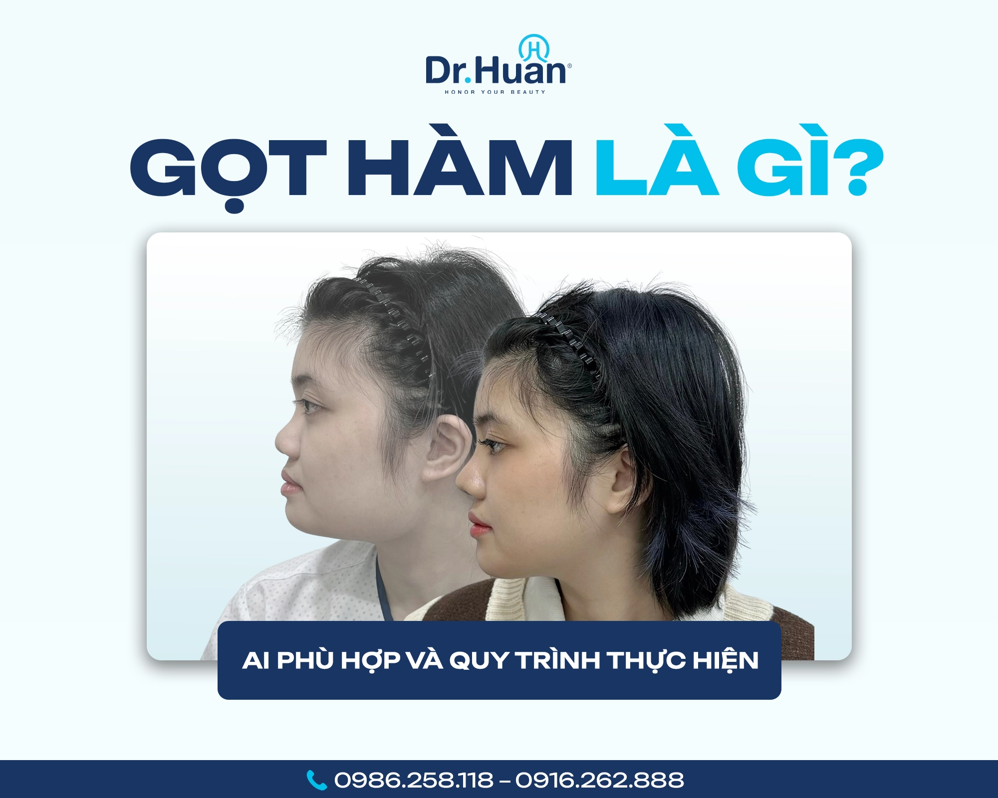 gọt hàm là gì