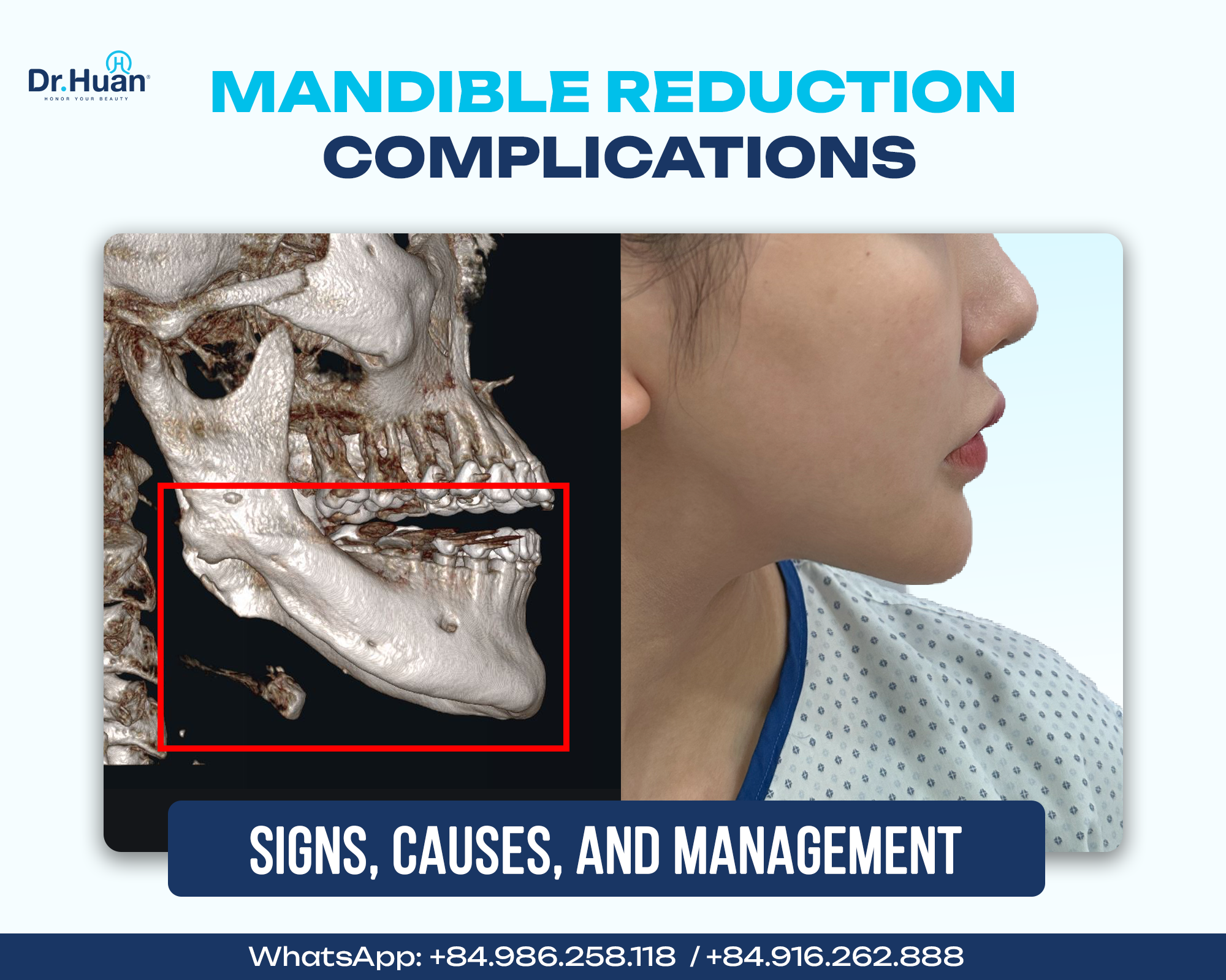 Mandible-Reduction-Complications