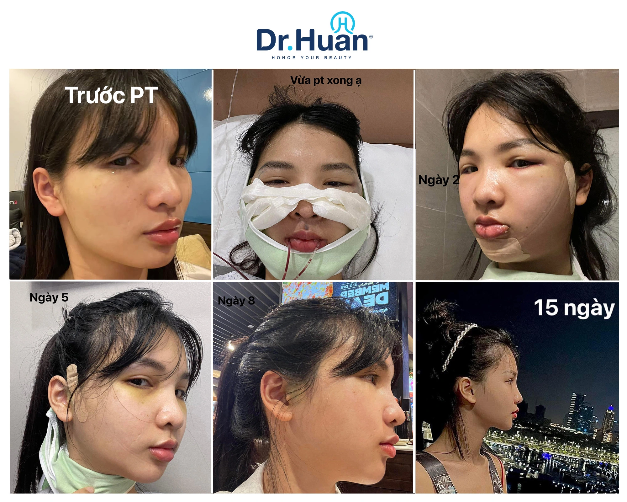 Quá trình hồi phục sau gọt hàm của khách hàng Dr Huân.