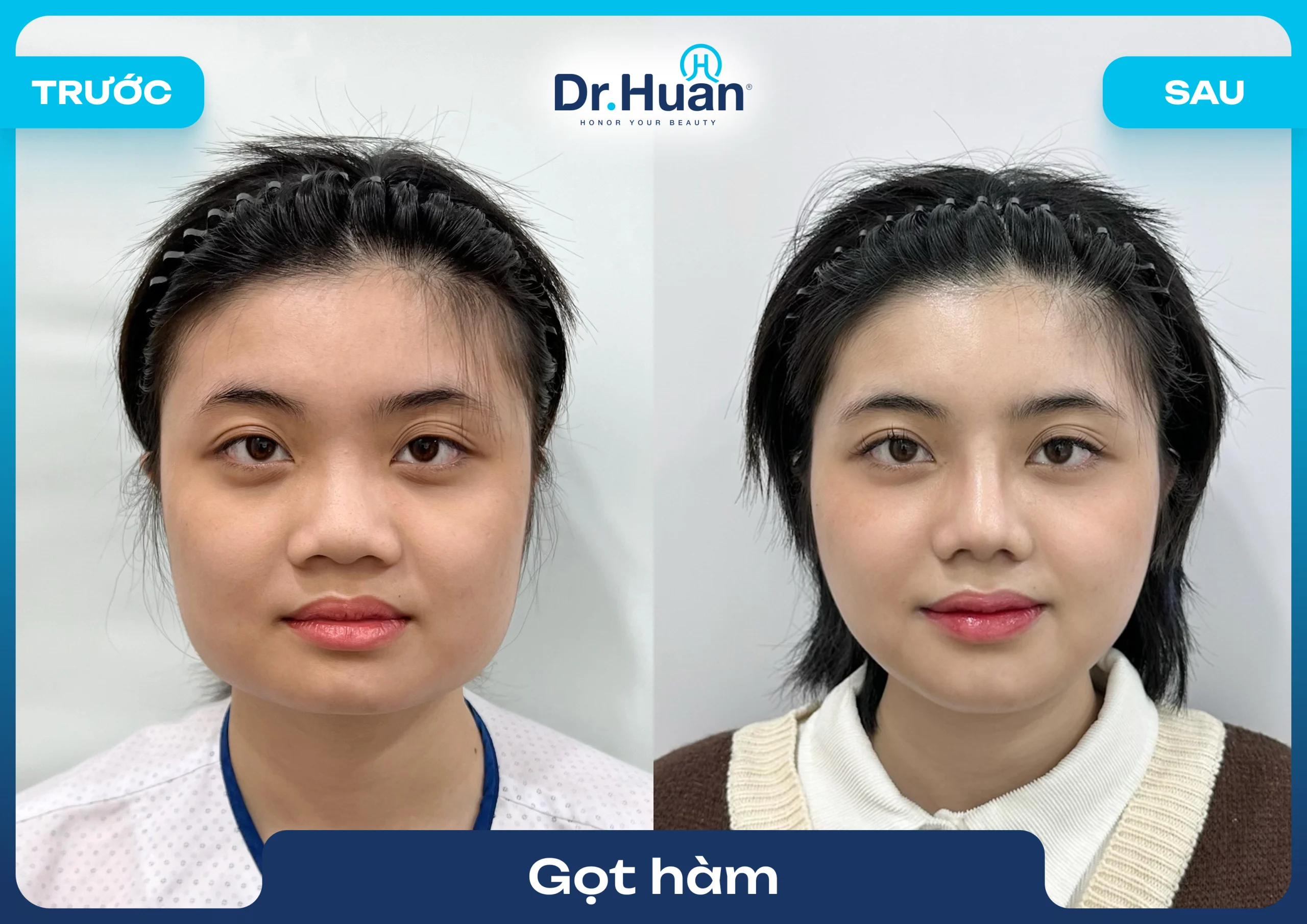 gọt hàm là gì