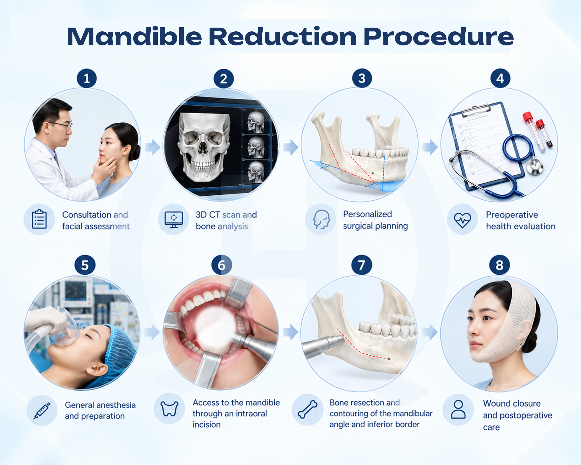 Mandible reduction procedure at Dr Huan