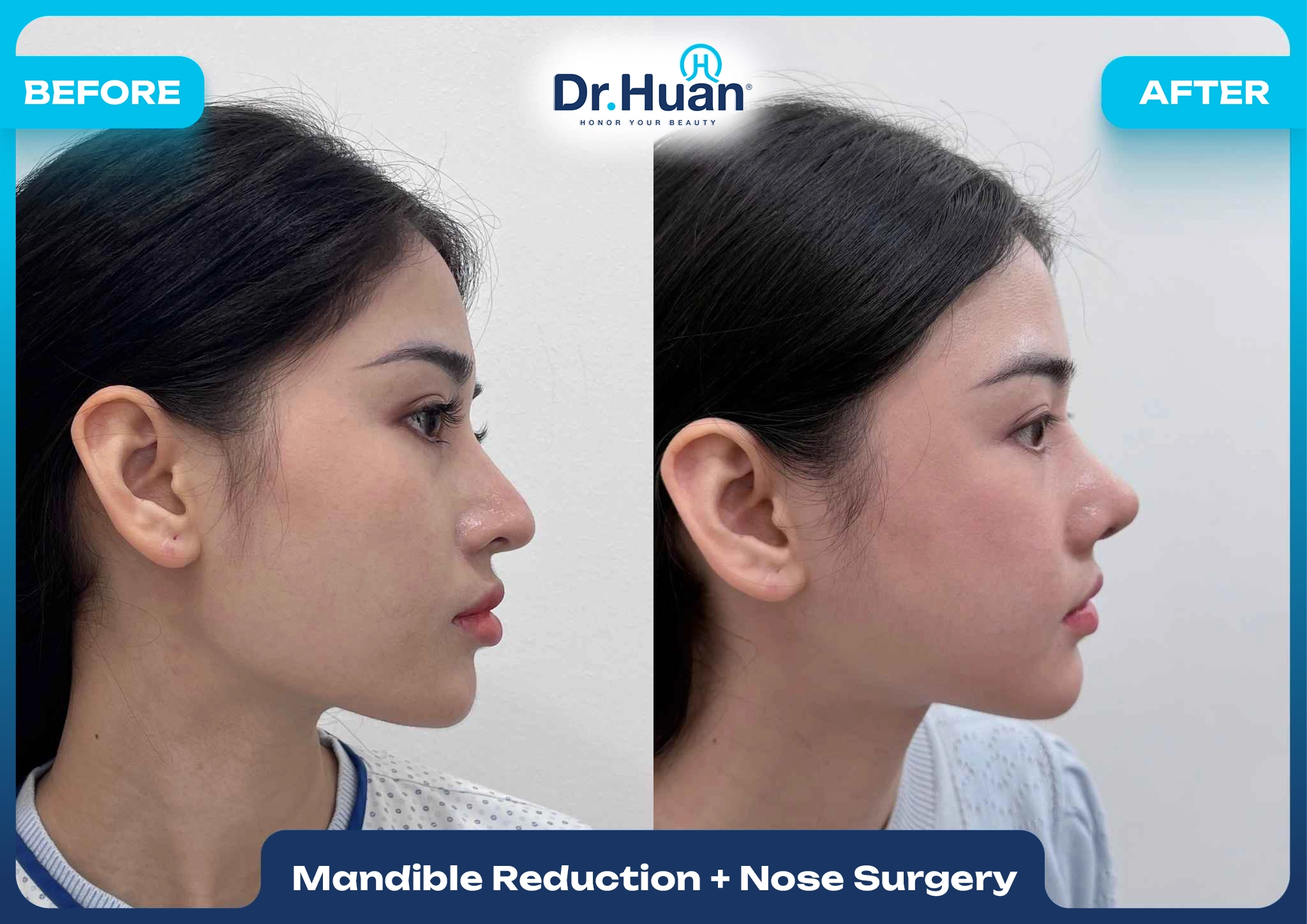 Results following mandible reduction and nose surgery performed by Dr Huân.