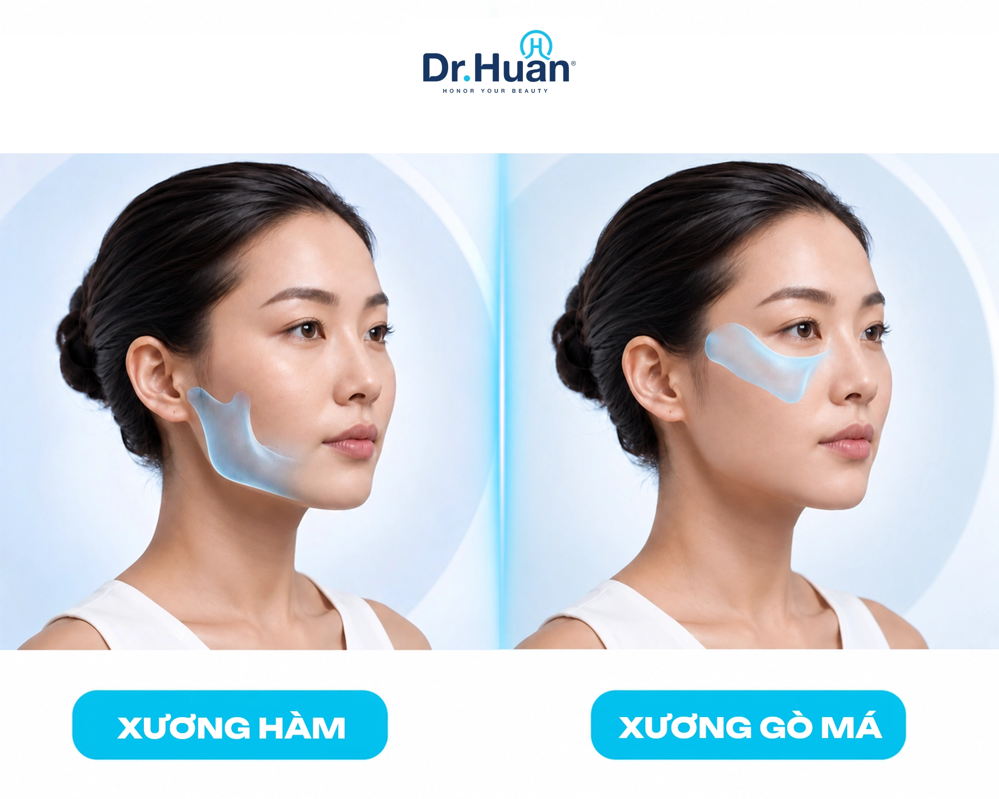 Vùng tác động của phẫu thuật gọt hàm hạ gò má