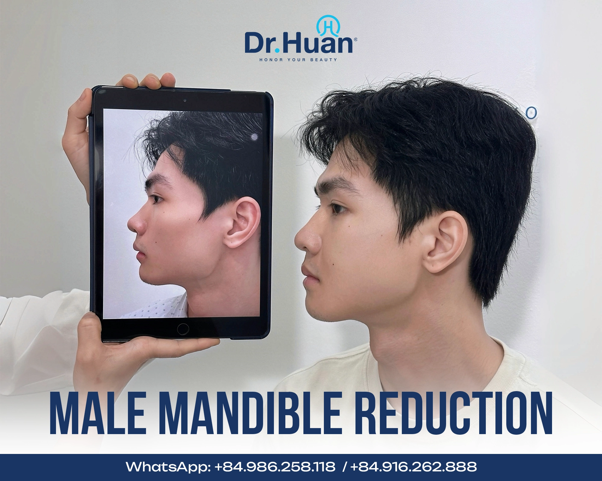Male mandible reduction