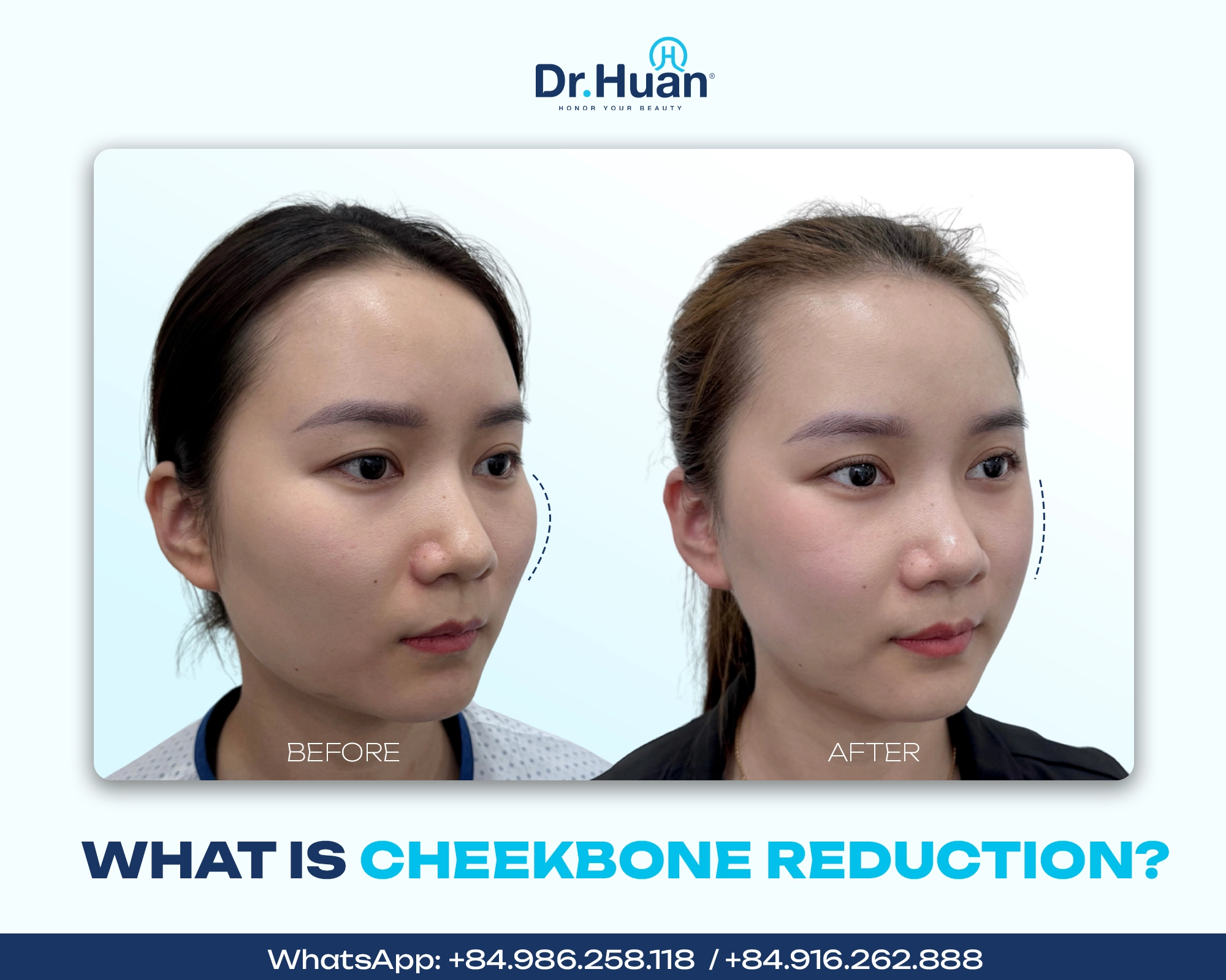 What-is-cheekbone-reduction